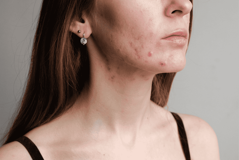 acne e alimentação